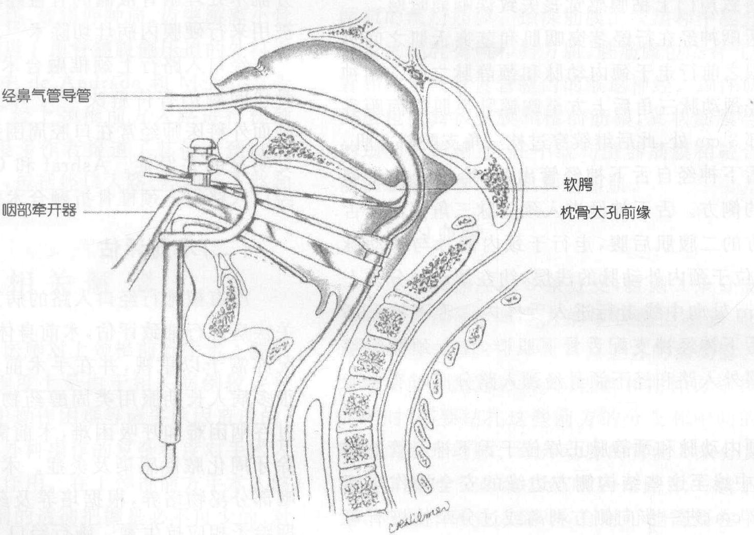 二、經(jīng)口腔手術(shù)入路